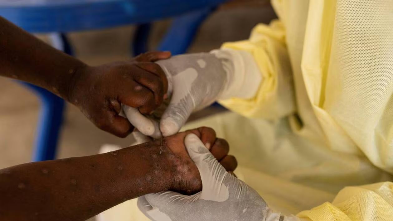 image Mpox en Afrique:  Le pays s’active